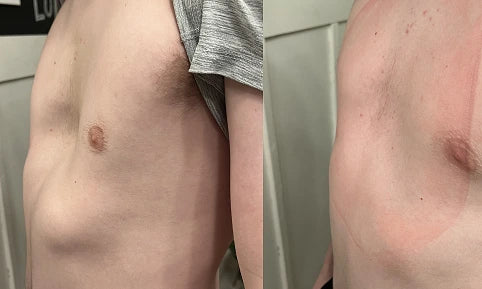 Vacuum Bell Therapy before and after