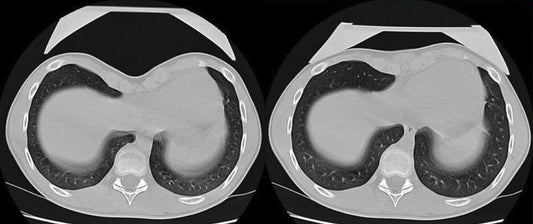 About Vacuum Bell Therapy for Pectus Excavatum