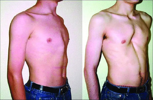 Pectus Excavatum vs Carinatum