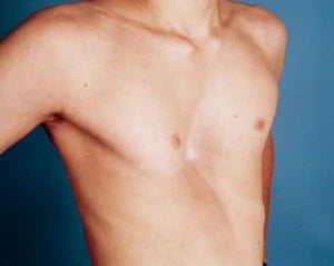 What is Pectus Excavatum?