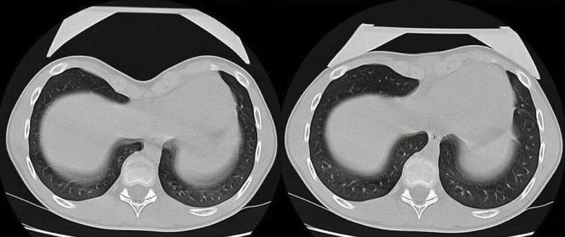 Vacuum Bell Pectus Excavatum