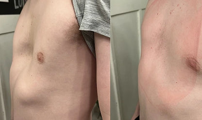 Vacuum Bell Therapy before and after